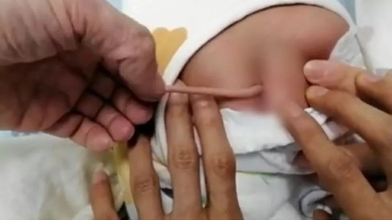 Bebê nasce com cauda em caso raro - (Foto: reprodução/Asiawire-Metro.co.uk)
