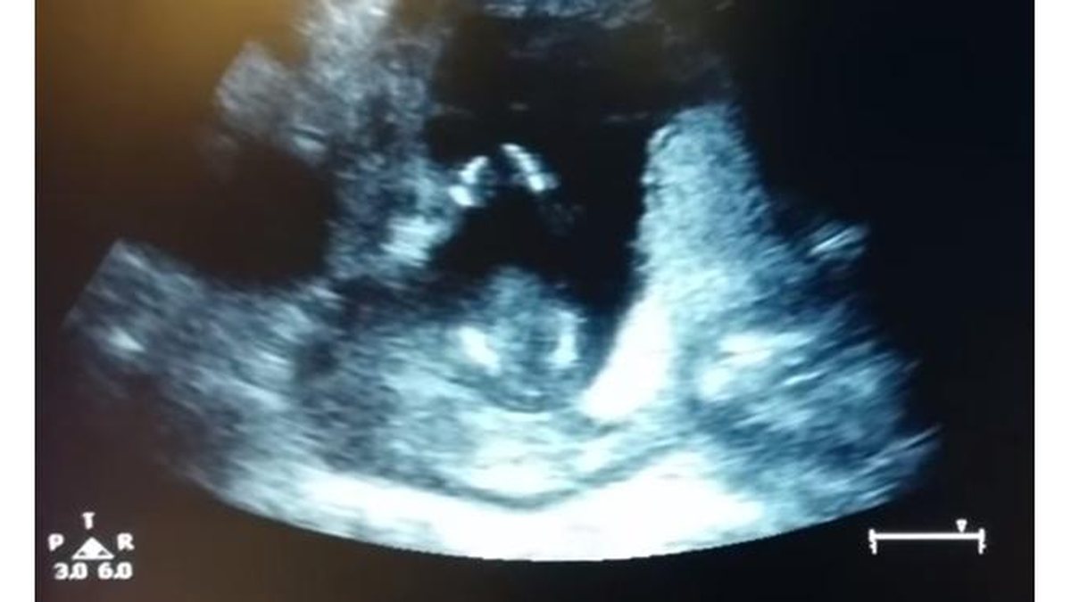 Imagem Ultrassom mostra bebê batendo palmas dentro da barriga da mãe
