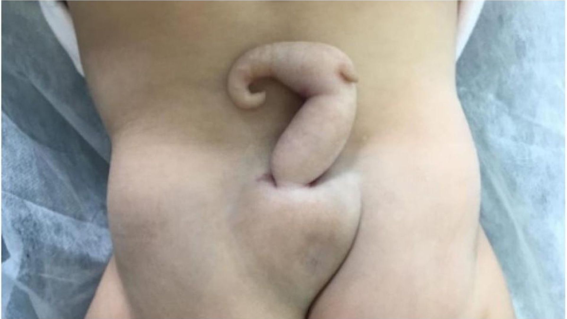 Bebê brasileira nasce com cauda