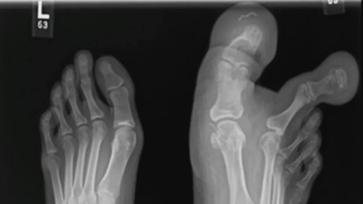 Menina tem gigantismo nos dedos do pé por condição rara - (Foto: reprodução/Cureus)