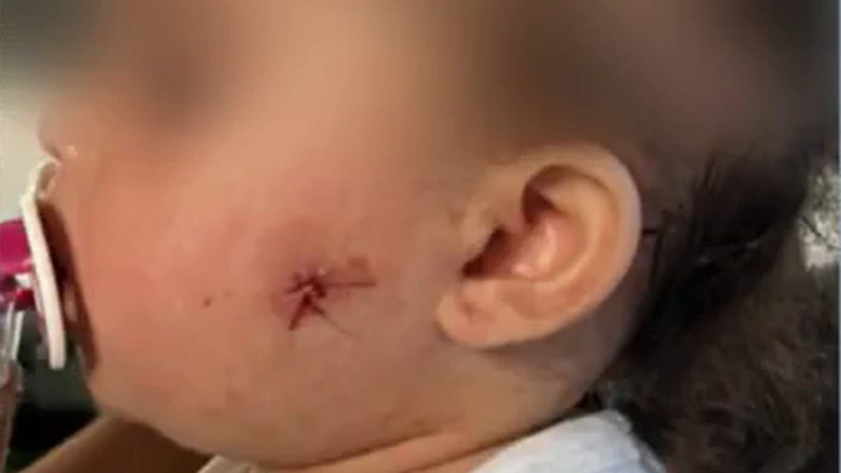 Menina de 1 ano leva tiro no rosto de bala de plástico disparada por PM - (Foto: Reprodução/TV Globo)