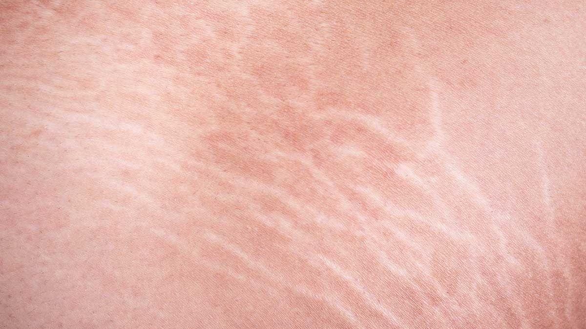 As estrias são lesões na pele que acontecem por causa do rompimento das fibras colágenas e elásticas, que são responsáveis por dar firmeza à pele. - Shutterstock