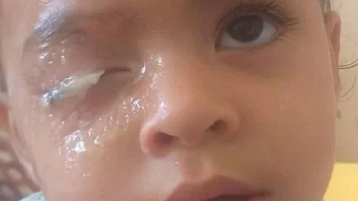 Criança de 2 anos gruda o olho com cola instantânea - Reprodução/Arquivo Pessoal Correio Braziliense