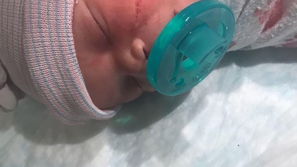 O bebê estava perto da parede da placenta, e por isso, os médicos acidentalmente cortaram seu rosto - Getty Images