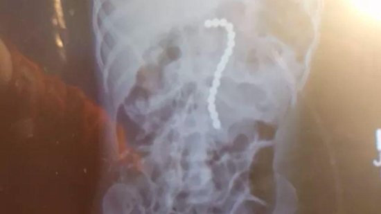 Mãe faz alerta após menino de 2 anos engolir 16 bolas magnéticas e passar por cirurgia - Reprodução/ Instagram
