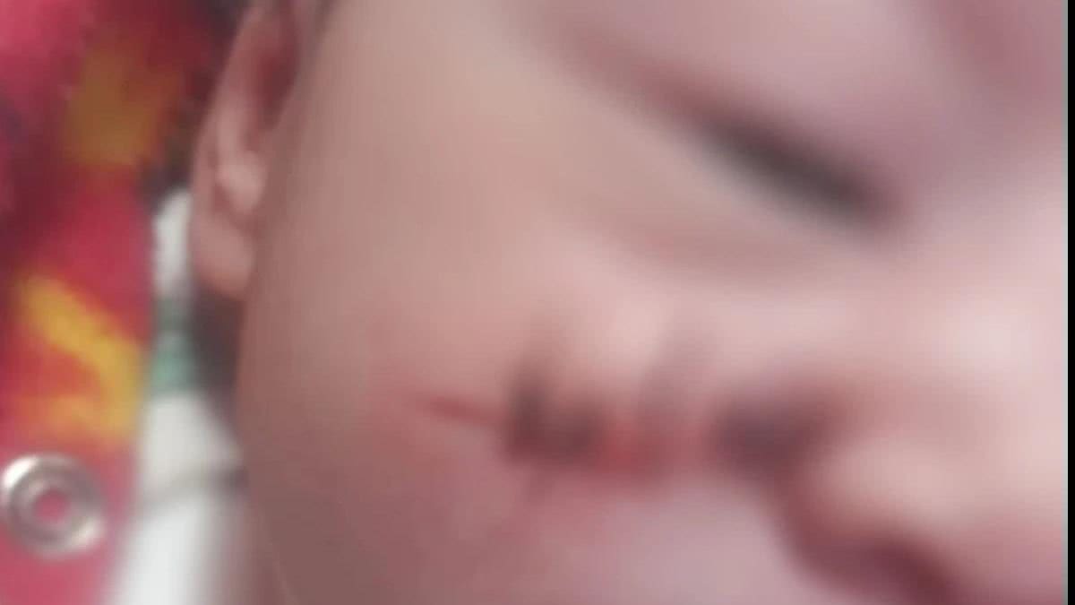 Bebê teve o rosto cortado em cesárea - Reprodução/ G1