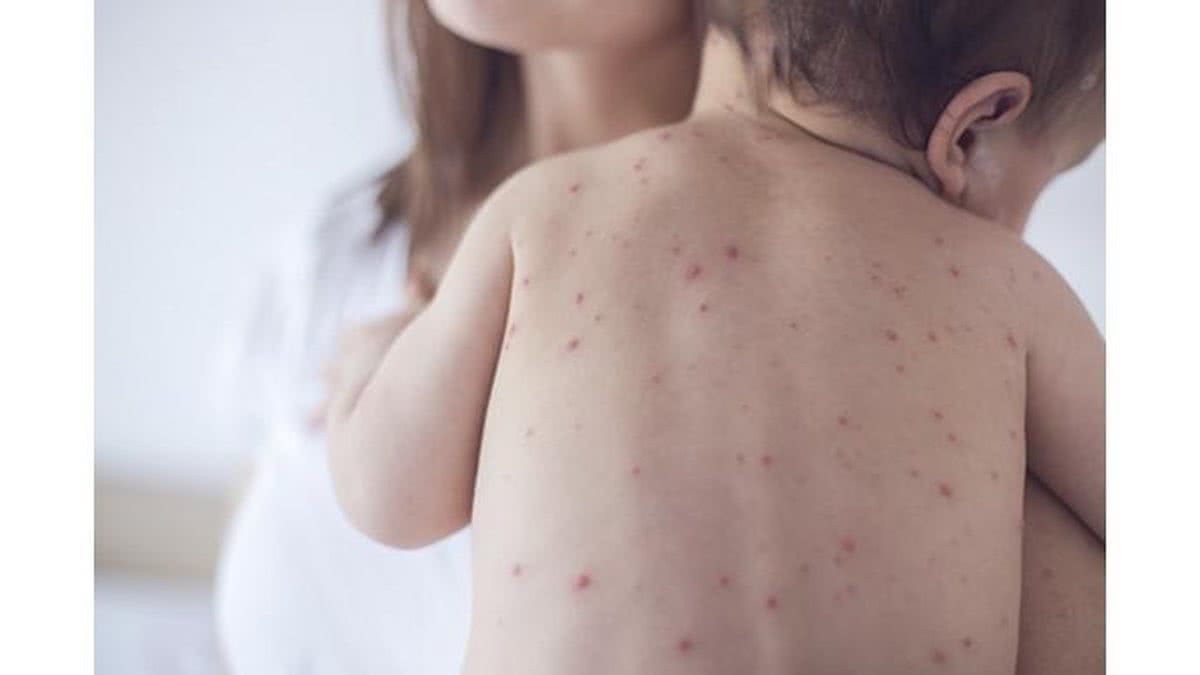 A nova campanha de vacinação contra Sarampo para crianças a partir dos 6 meses começou no dia 07 de outubro - Getty Images
