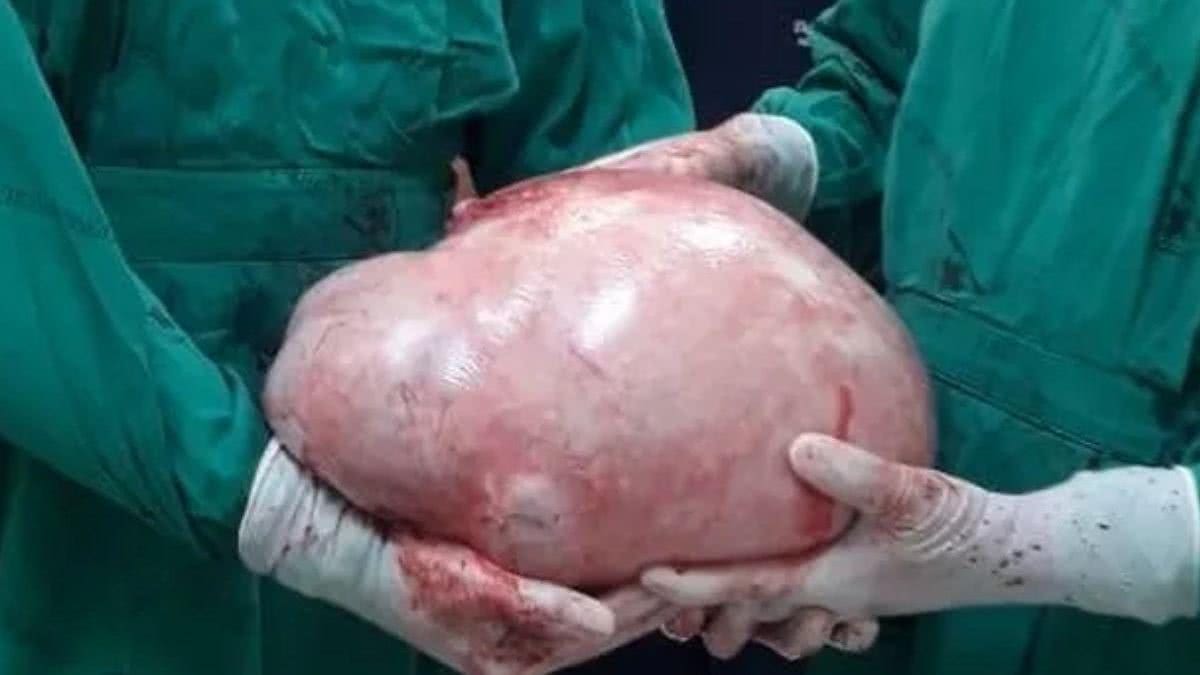 O tumor pesa quase 20 kg - Arquivo Pessoal