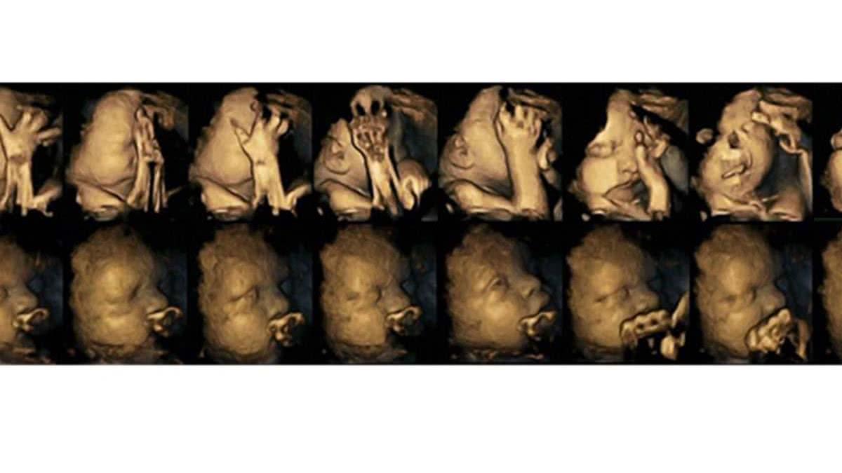 Imagem Ultrassom mostra reação de bebês na barriga de mães fumantes