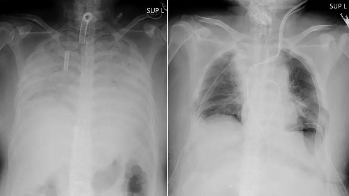 O primeiro transplante de pulmão com doadores vivos foi feito no Japão. O tórax de um paciente antes da cirurgia (à esquerda) e depois - Reprodução/ G1