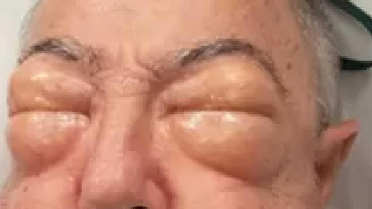 Um australiano de 75 anos teve corpo e rosto alterados após passar por cirurgia - Divulgação/Epworth HealthCare
