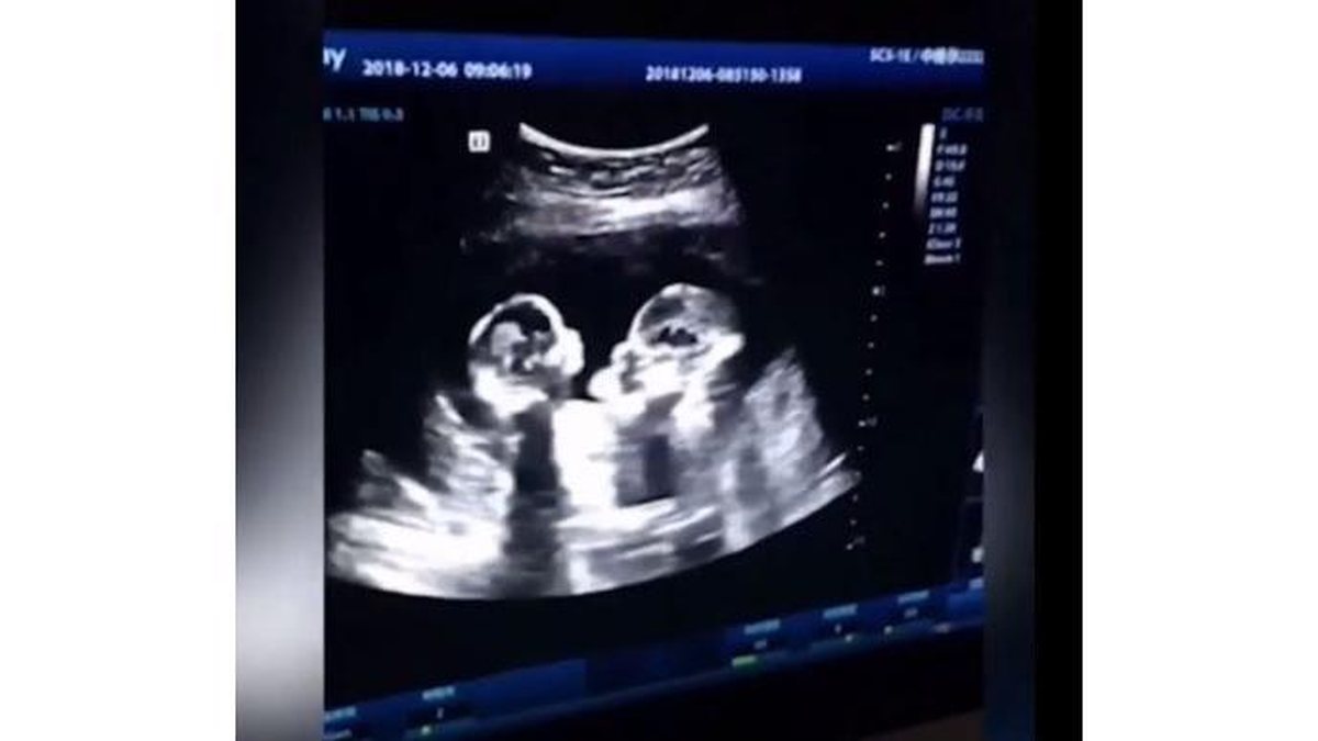 Imagem Vídeo mostra gêmeas “brigando” no ultrassom e pai se diverte: “Achei engraçado”