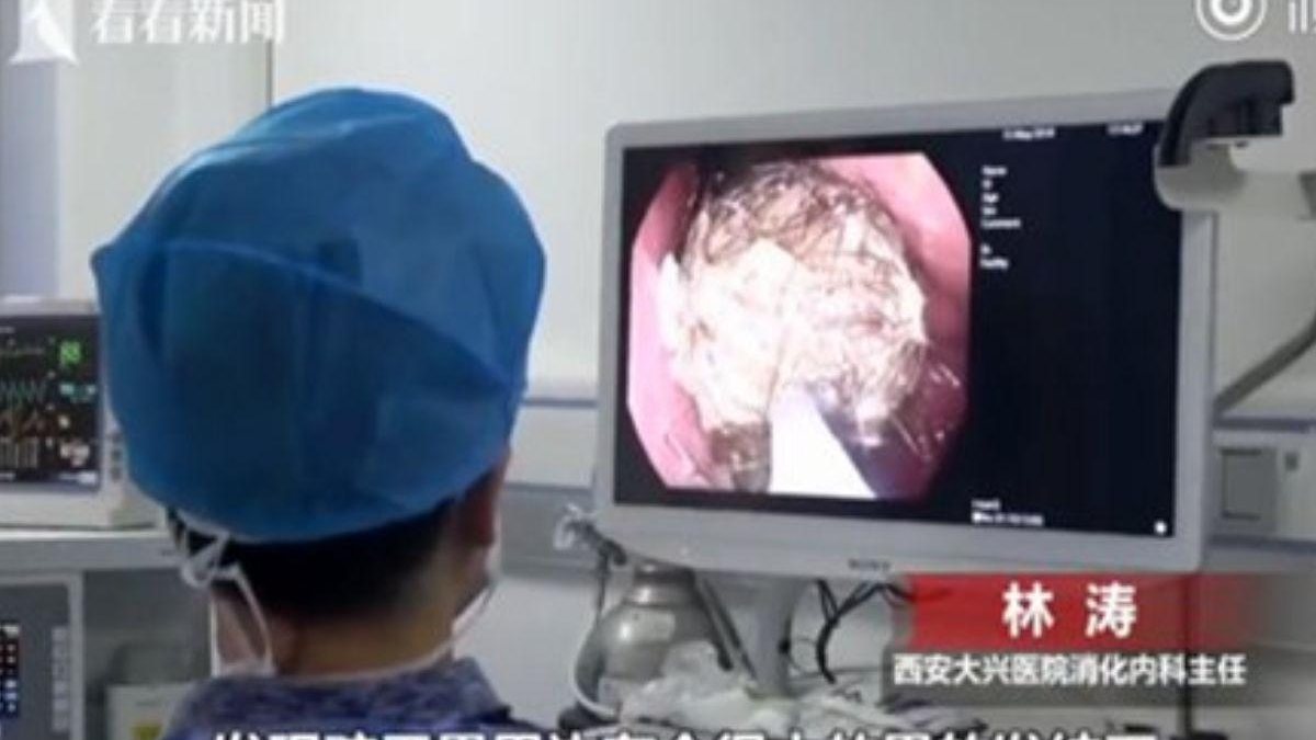 Imagens da endoscopia realizada na chinesa Xio Lin - Reprodução / Knews