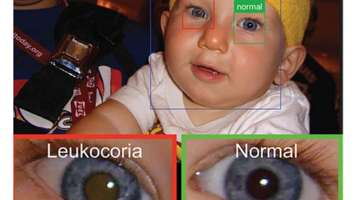 Eles estudaram mais de 50 mil fotos de 40 crianças para criar o banco de dados capazes de identificar as doenças oculares - Reprodução/WBAA