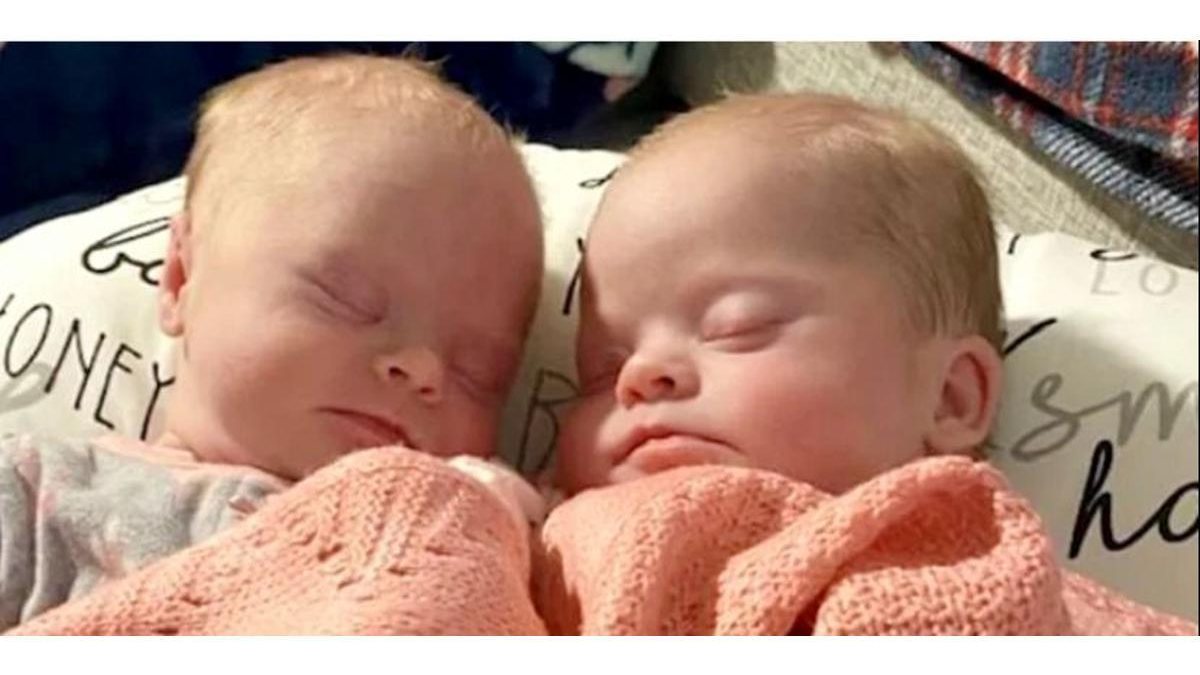 O caso das gêmeas com síndrome de down é muito raro - Reprodução/ Today/ Savannah Combs