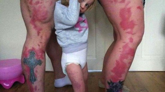 Pais tatuam marca de nascença da filha na perna para que ela se sinta mais bonita - reprodução Mirror