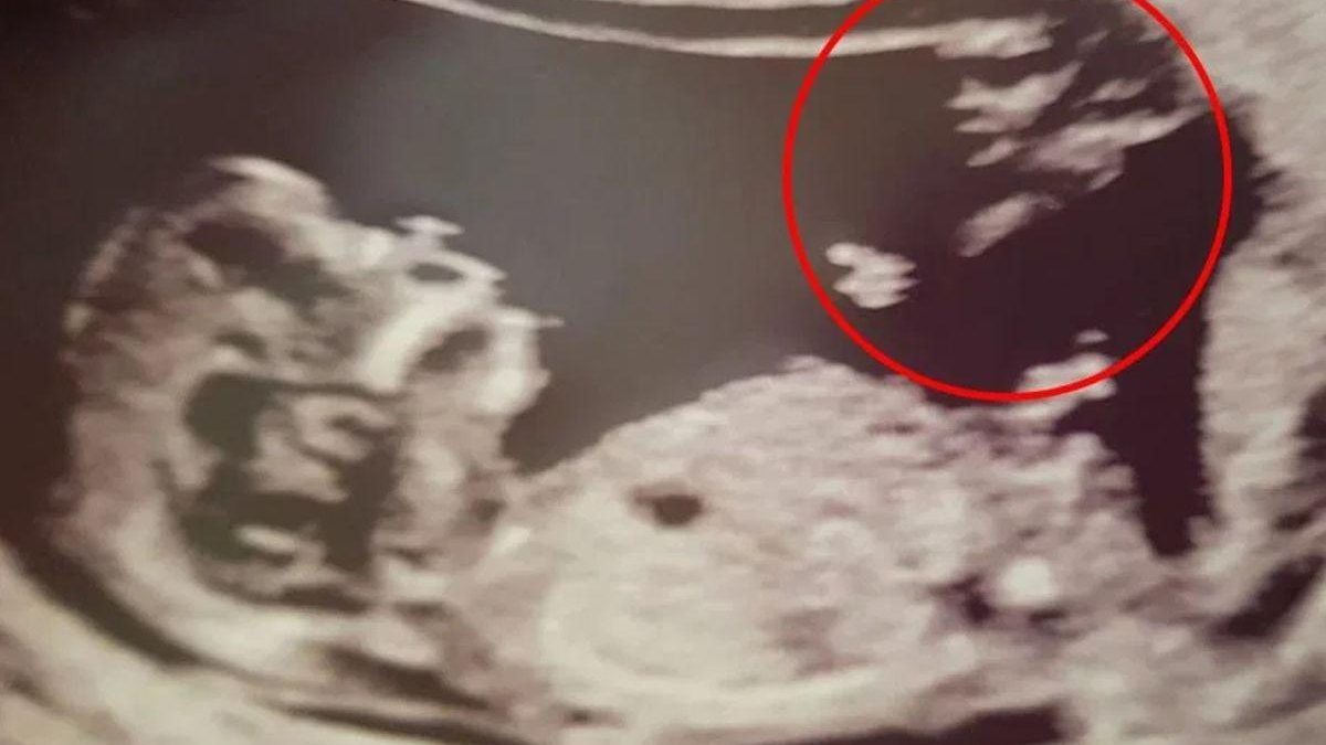 Ela se surpreendeu no ultrassom de 12 semanas - reprodução / Getty Images