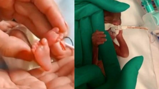 Emanuelly é a menor bebê já registrada em hospital público no Brasil - Reprodução/Fantástico/TV Globo