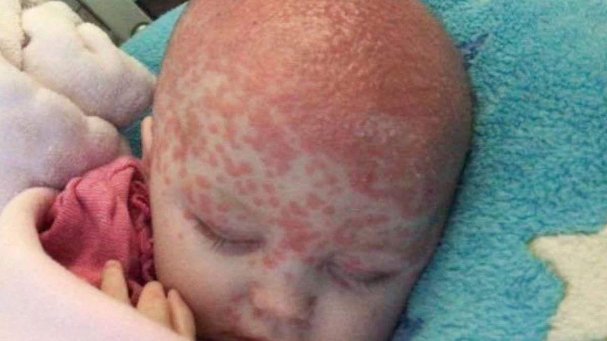 Garota de apenas 6 meses pega herpes através do toque - Hollie Cruickshanks