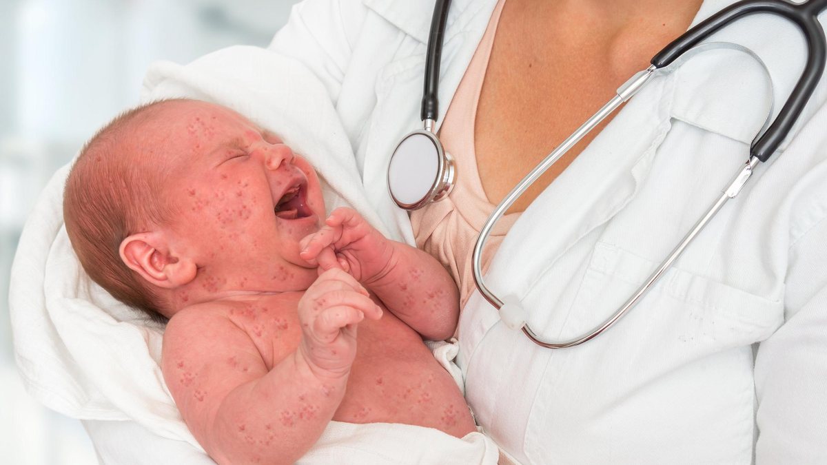 O sarampo pode ser combatido apenas com a vacina - Getty Images