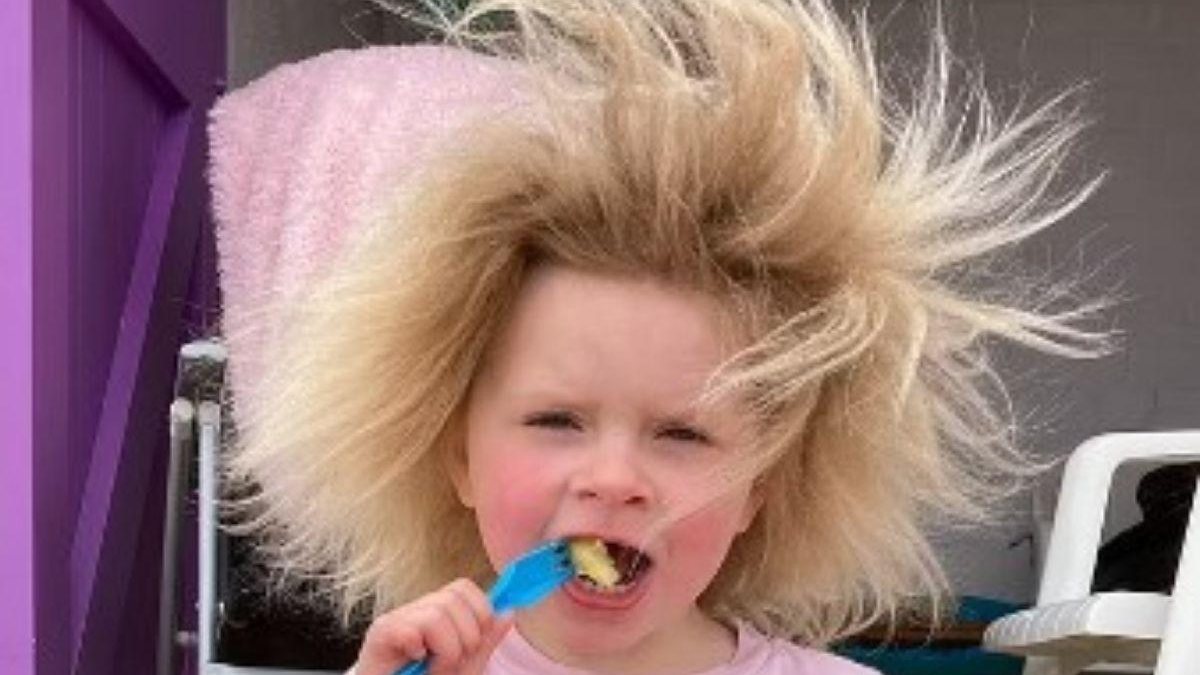 A menina nasceu com a ‘síndrome do cabelo impenteável’ - Reprodução/Daily Mail