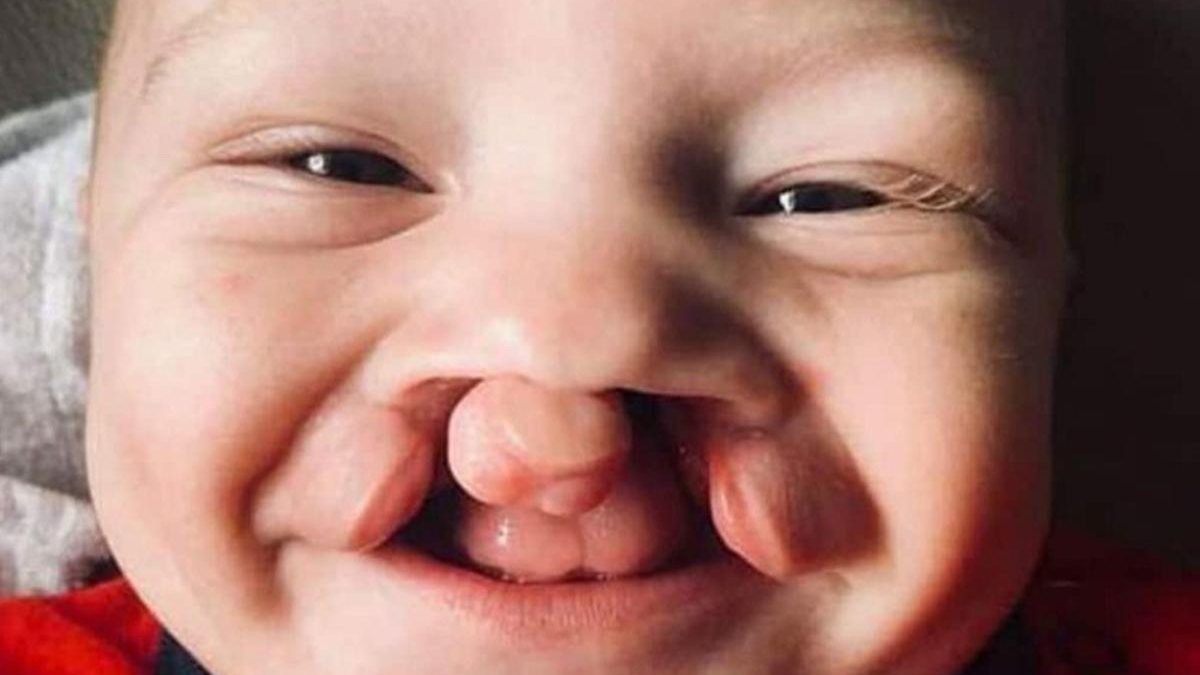 Mãe mostra resultado da cirurgia de lábio leporino do filho de 1 ano e 4 meses - reprodução / Facebook