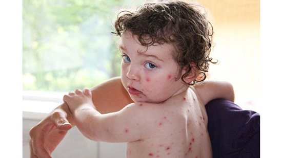 Vacinação é a única proteção do seu filho contra algumas doenças - GettyImage