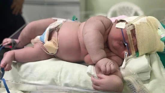 O ‘bebê gigante’ nasceu em Amazonas - Divulgação/Hospital Padre Colombo
