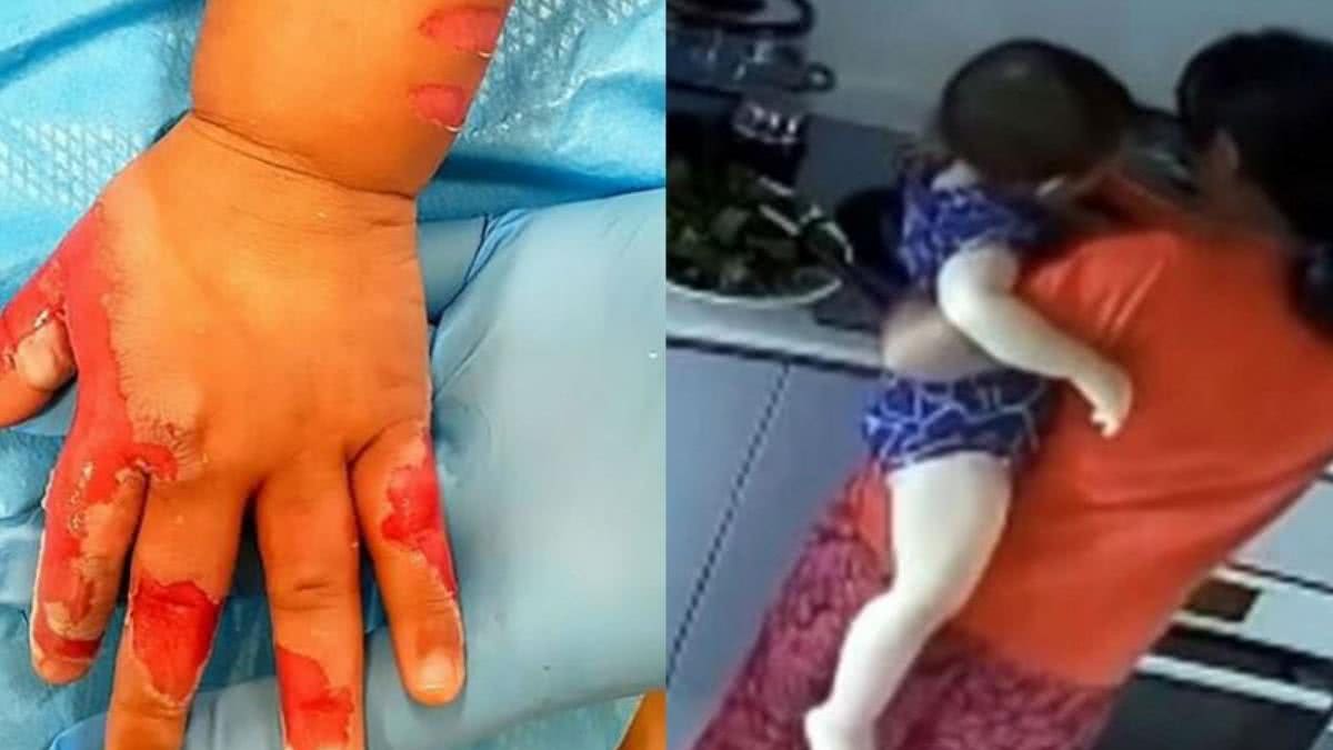 A babá queimou a mão do bebê de propósito - Reprodução / Daily Mail