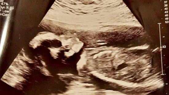 Mãe fica assustada com ultrassom da filha: “O crânio apareceu” - Reprodução: Tasmin Stenhouse