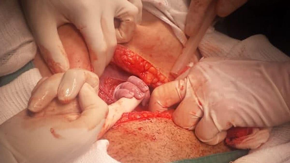 Letícia nasceu de uma cesárea - reprodução / G1