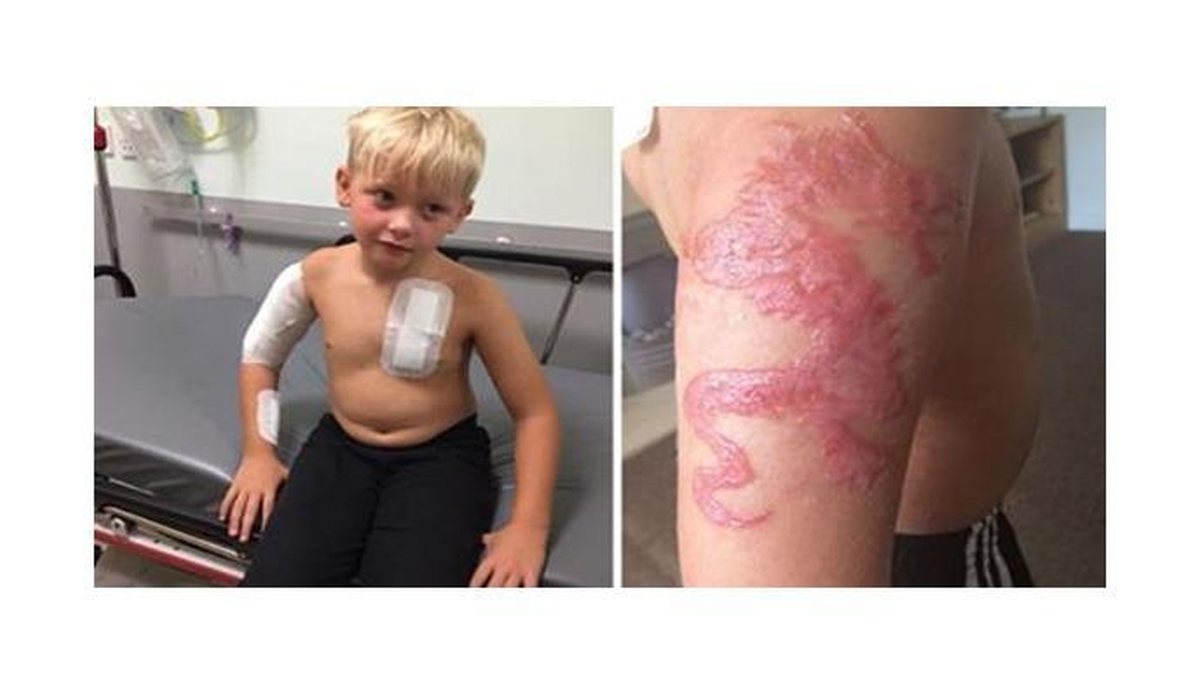 Owen no Hospital já com ataduras e a cicatriz da queimadura (Foto: Reprodução/Facebook 