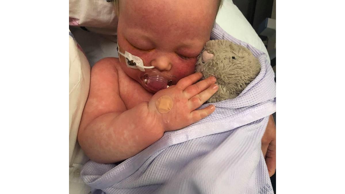 Por conta do inchaço, a bebê ficou sem abrir os olhos por quatro dias (Foto: reprodução/ Facebook