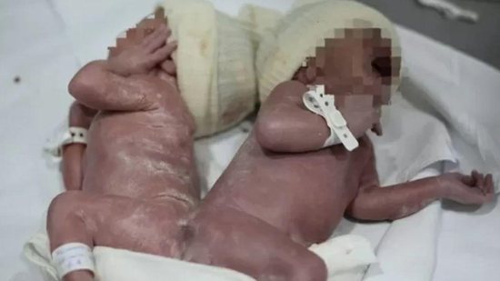 Gêmeos siameses nascem em Curitiba - Divulgação: Hospital do Rocio