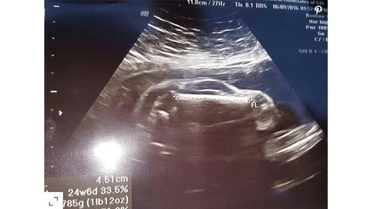 Durante o ultrassom há muita expectativa, mas a imaginação deste pai foi bem longe – Imagem ilustrativa - Getty Images