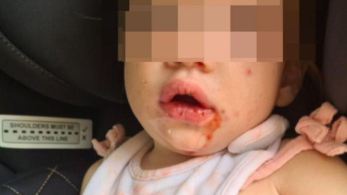 A menina ficou com diversas feridas na boca devido a herpes - Reprodução/ Instagram @tinyheartseducation/The Mirror