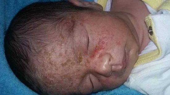 O bebê contraiu herpes - Reprodução/Facebook