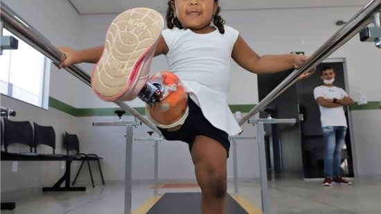 Menina de 3 anos dá os primeiros passos após ganhar prótese feita só para ela: “Realizando sonho” - reprodução Razões para Acreditar / Marcos Sandes/Prefeitura de Araguaína
