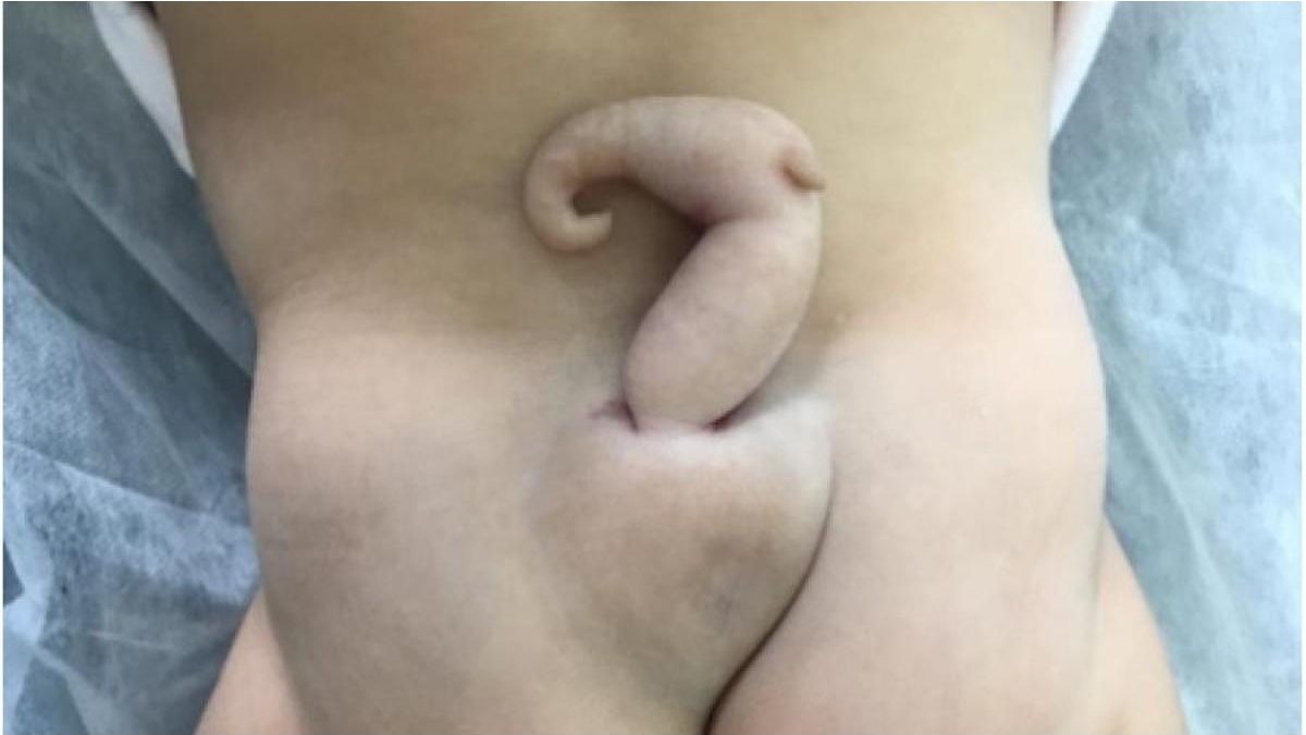 Bebê nasce com ‘cauda’ de 6 centímetros no Brasil e caso raro é divulgado - Reprodução