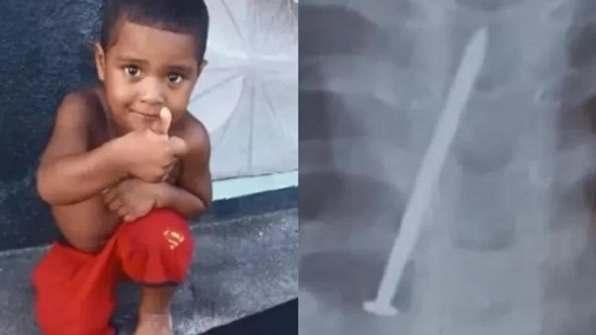 Um menino de três anos morreu após ficar um ano com um prego no pulmão. - Reprodução / Metrópoles