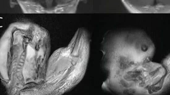O feto cresceu dentro do crânio da irmã - Divulgação/Huashan Hospital