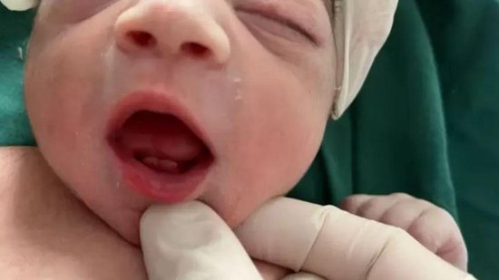 Bebê nasce com dois dentes - Fundação de Saúde