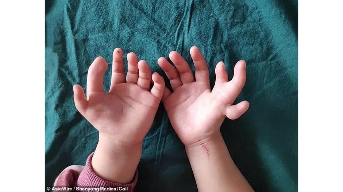 Imagem Menina nasce com 14 dedos e passa por uma cirurgia transformadora: veja o antes e depois