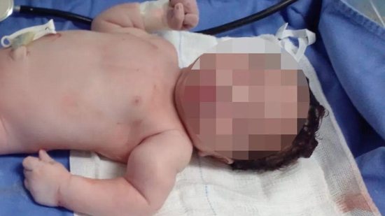 O bebê teve o braço quebrado durante o parto - Reprodução/TV Bahia