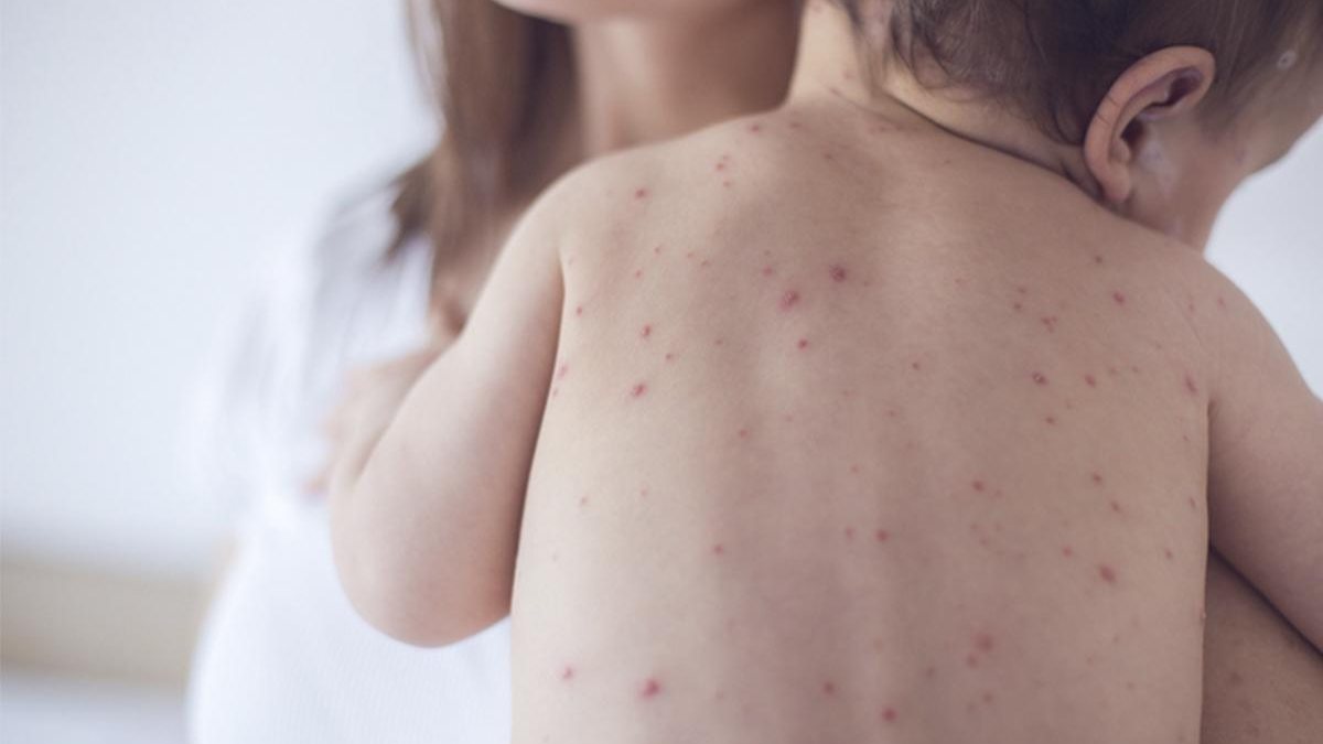 Imagem Alerta: casos de sarampo entre crianças de até dois anos aumentam em São Paulo