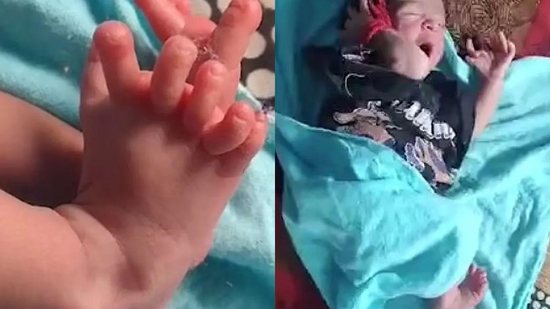 A bebê nasceu com 26 dedos - Reprodução/Daily Mail