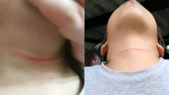 A mãe viu marcas no pescoço da criança quando voltou da escola - Getty Images
