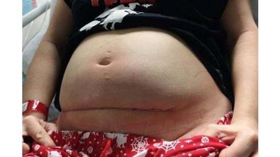 Cicatriz de Bethan após a cirurgia - reprodução/Facebook