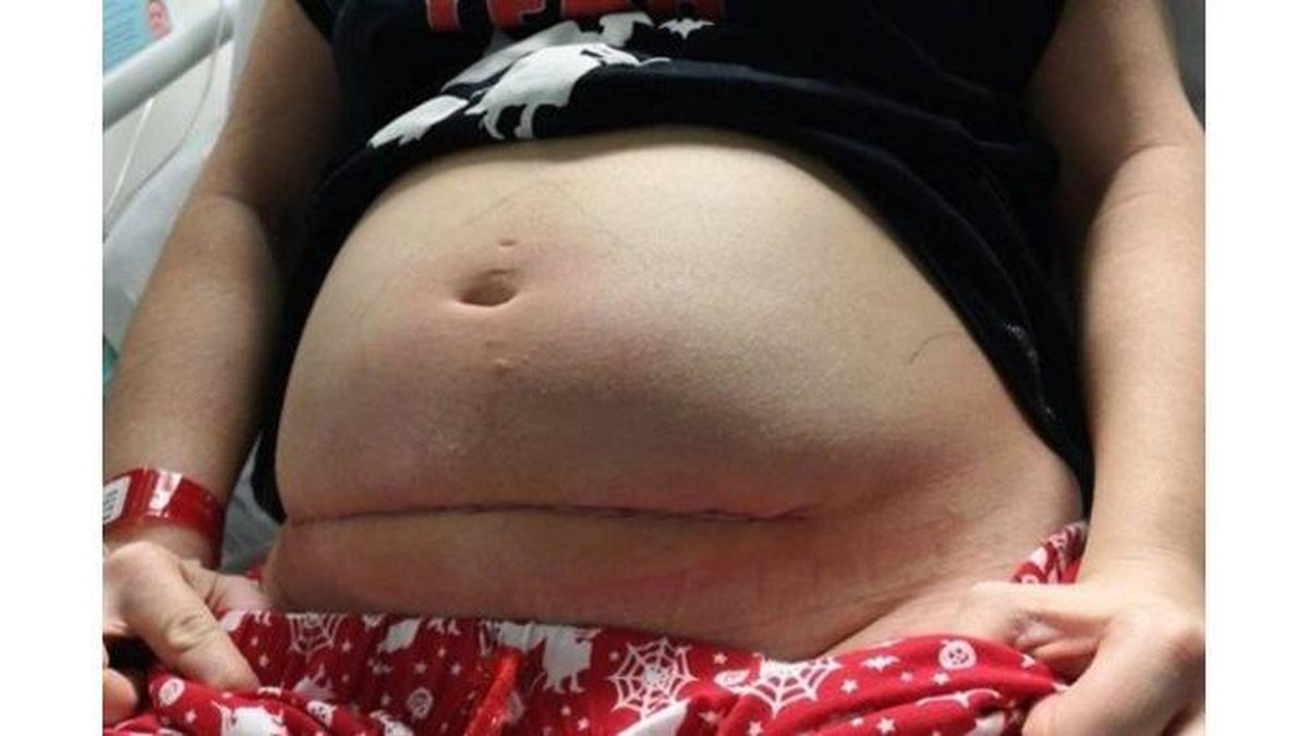 Cicatriz de Bethan após a cirurgia - reprodução/Facebook