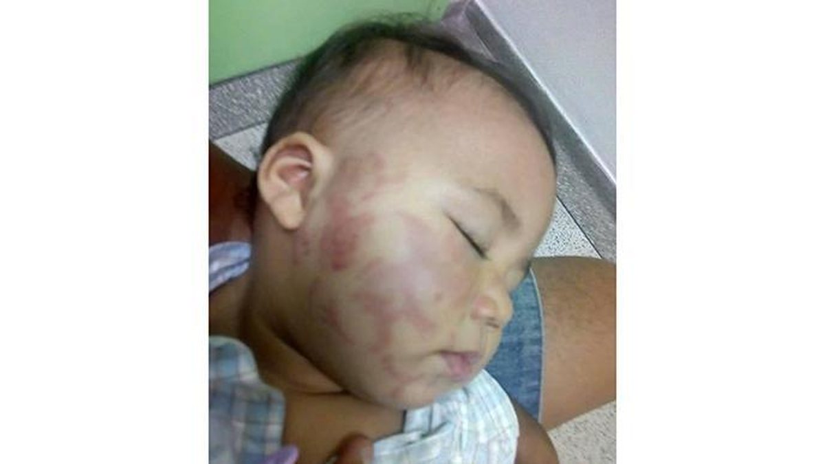 As marcas no rosto do bebê impressionam (Foto: Reprodução Facebook / 